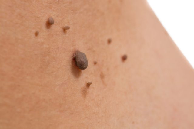 skin of a woman with moles