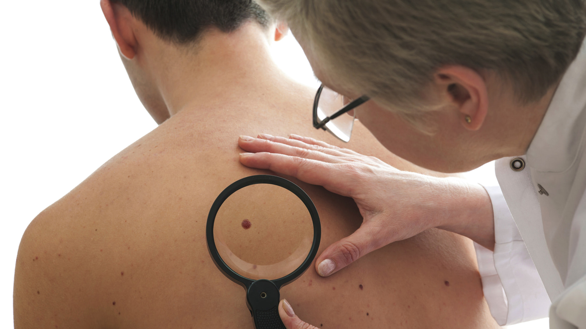 A Generic Photo of a doctor examining a mole which could be skin cancer. See PA Feature HEALTH Skin Cancer. Picture credit should read: PA Photo/thinkstockphotos. WARNING: This picture must only be used to accompany PA Feature HEALTH Skin Cancer. URN:20076011